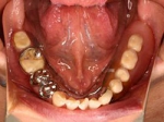 両側5歯症例