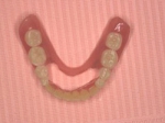 義歯の調整