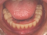 義歯の調整