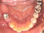 片側2歯欠損